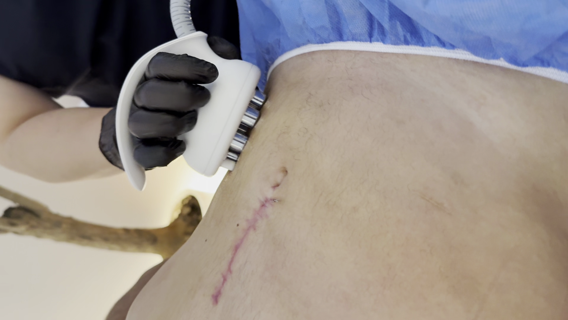 Masaje Post-Operatorio Post-Quirurgico en Zapopan – Très Belle Derma Clinique, cerca del Tec de Monterrey