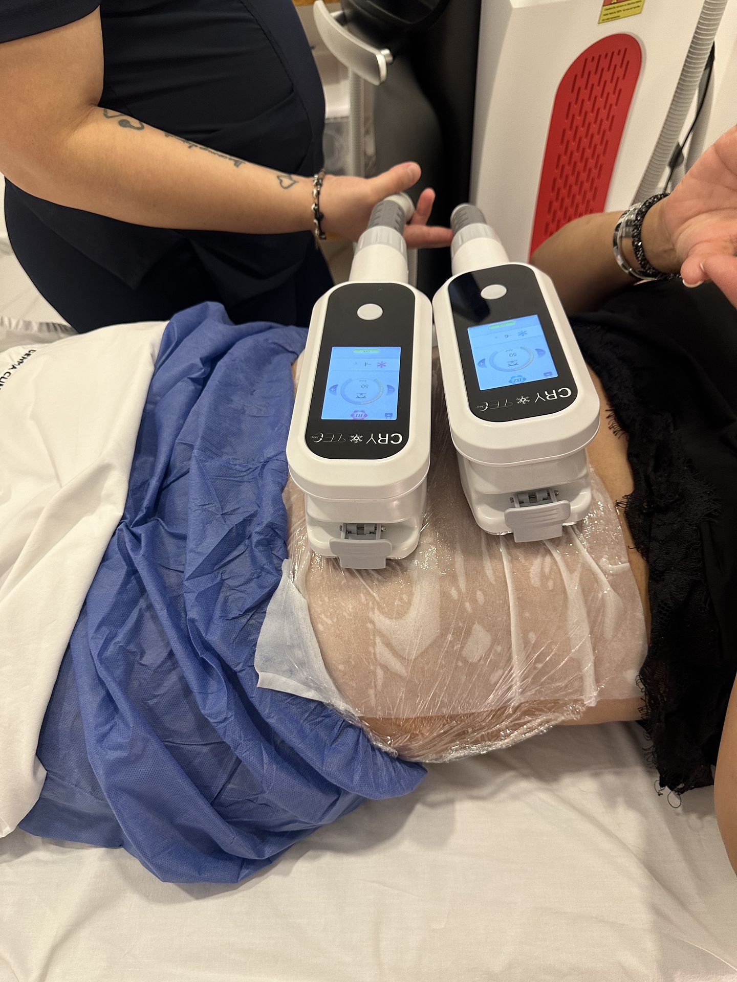 Criolipólisis en Zapopan – Très Belle Derma Clinique, cerca del Tec de Monterrey